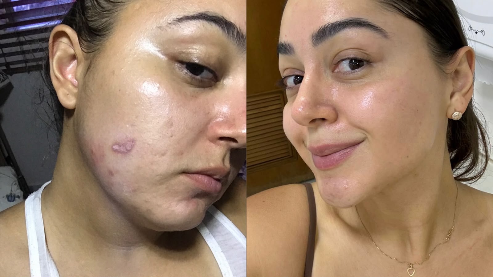 Comparação antes e depois: acne inflamada e marcas no rosto dão lugar a uma pele calma e uniforme