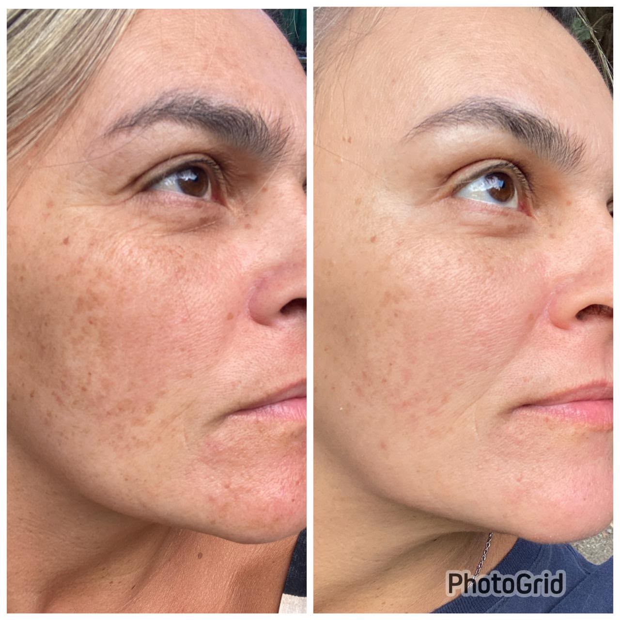 Comparação antes e depois: melasma e manchas solares no rosto ficam visivelmente mais claros